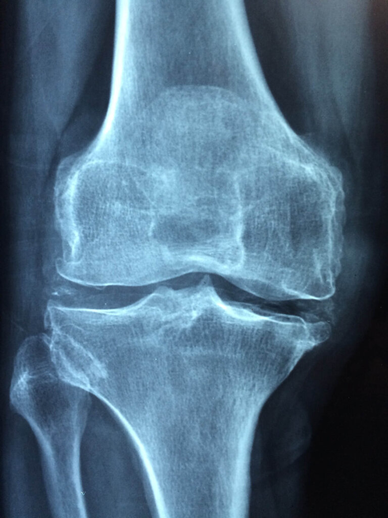 l'articolazione del ginocchio si forma tra femore e tibia